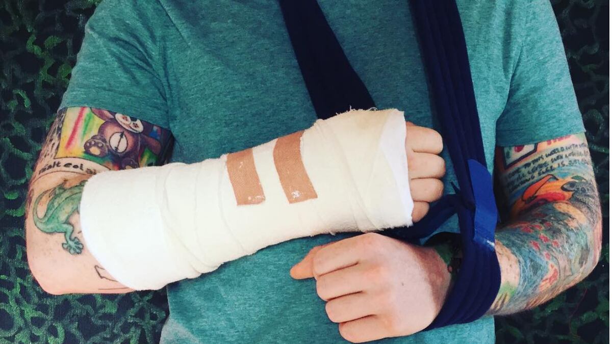 ed-sheeran-injury_ozd028