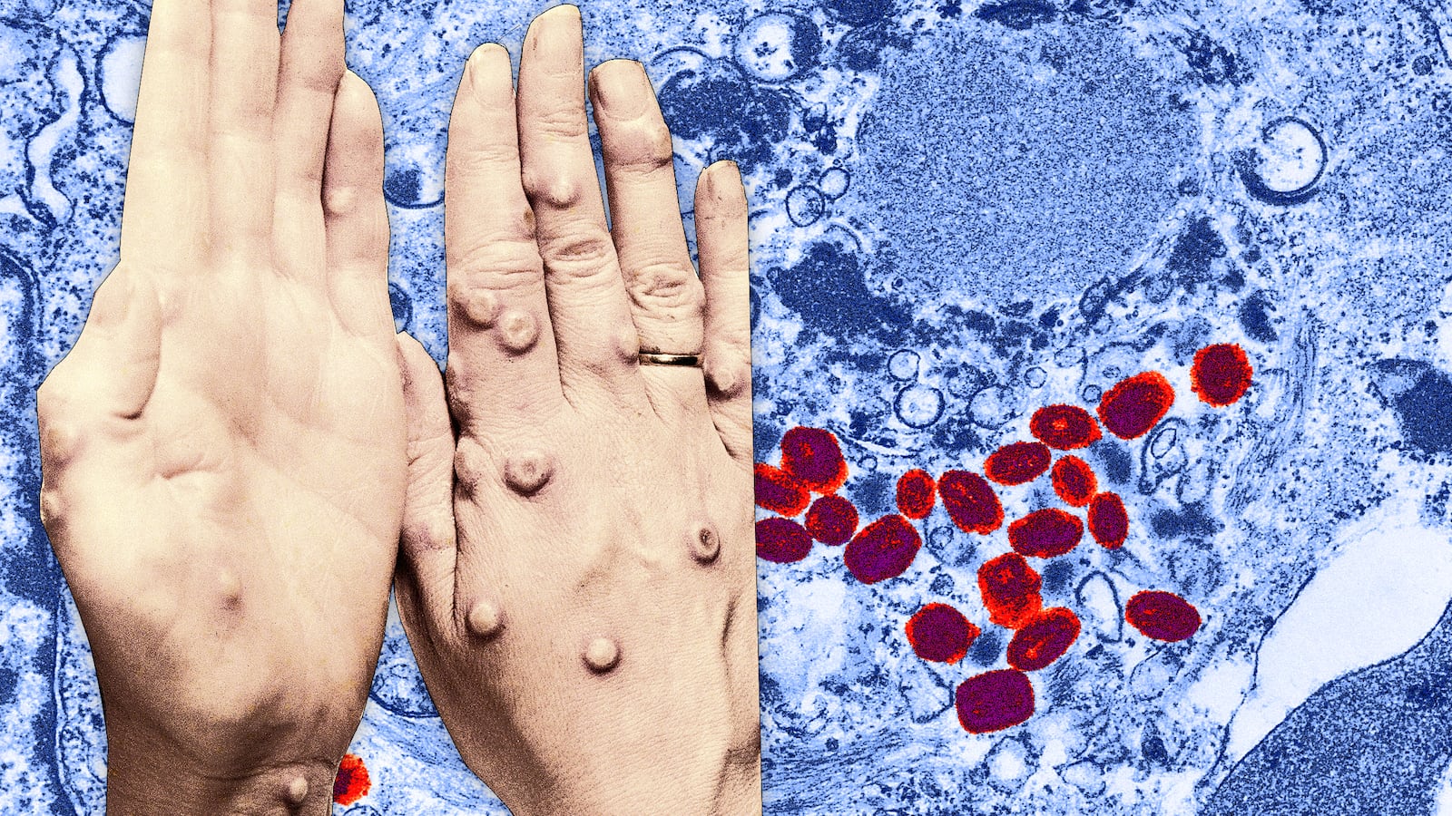 180331-Basu-smallpox-hero_yz3nlj