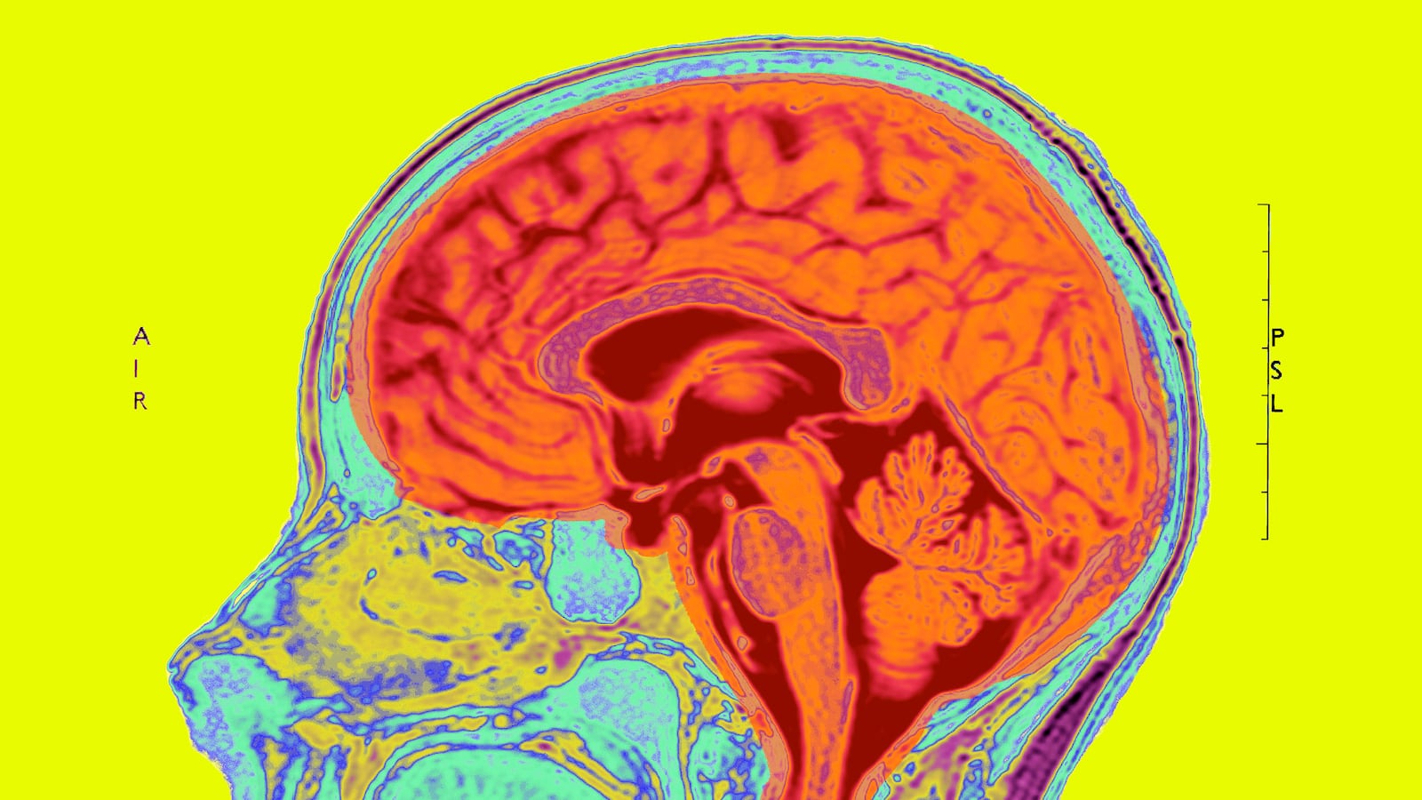 articles/2014/09/07/early-brain-injury-might-be-the-root-of-autism/140905-autism-brain-injury-tease_rmwvls