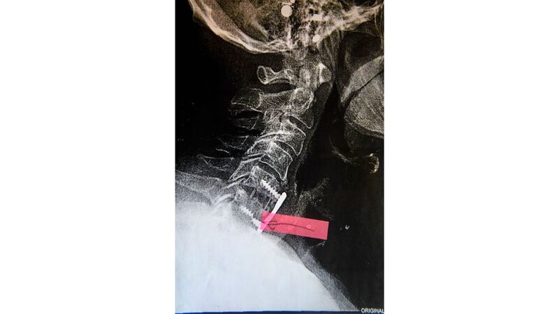 210806-KHN-implants-embed-02_v93lnf