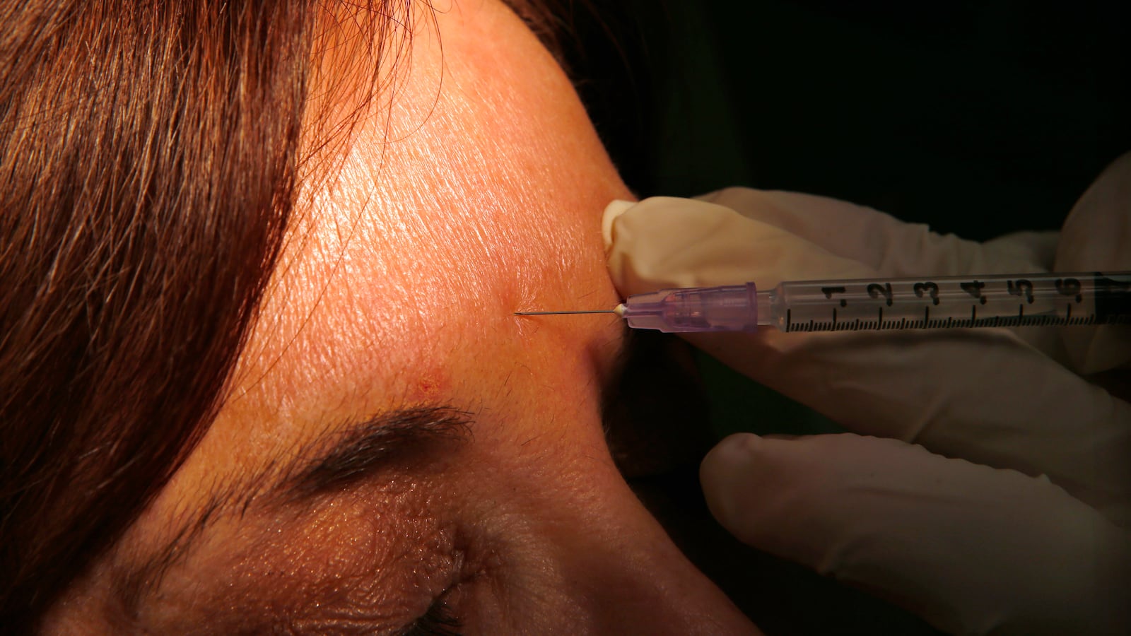 A dermatologist demonstrates how botox or other anti-wrinkle medicines are applied via syringe to a patient at his office in New York City, March 22, 2013.