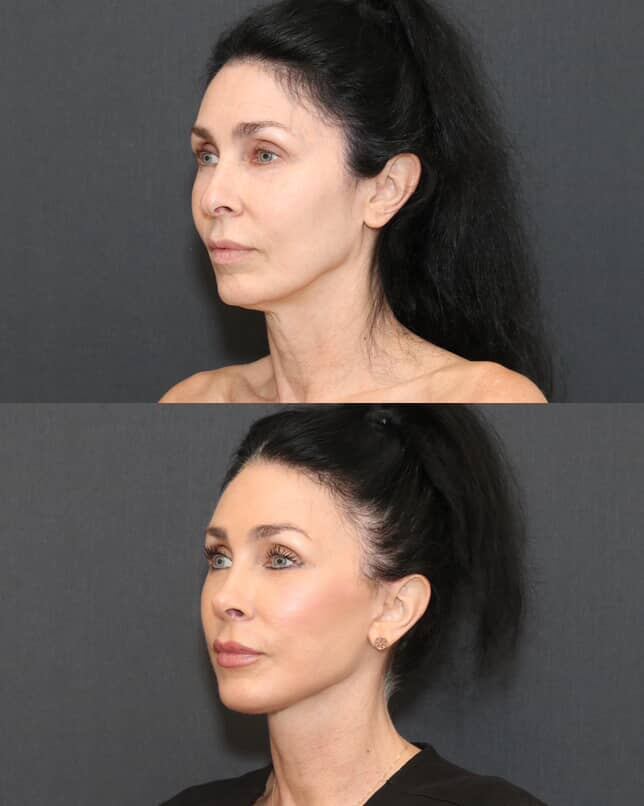 Side profile transformation of Dr. L. Mike Nayak’s patient, Kelly Morgan — before and after.
