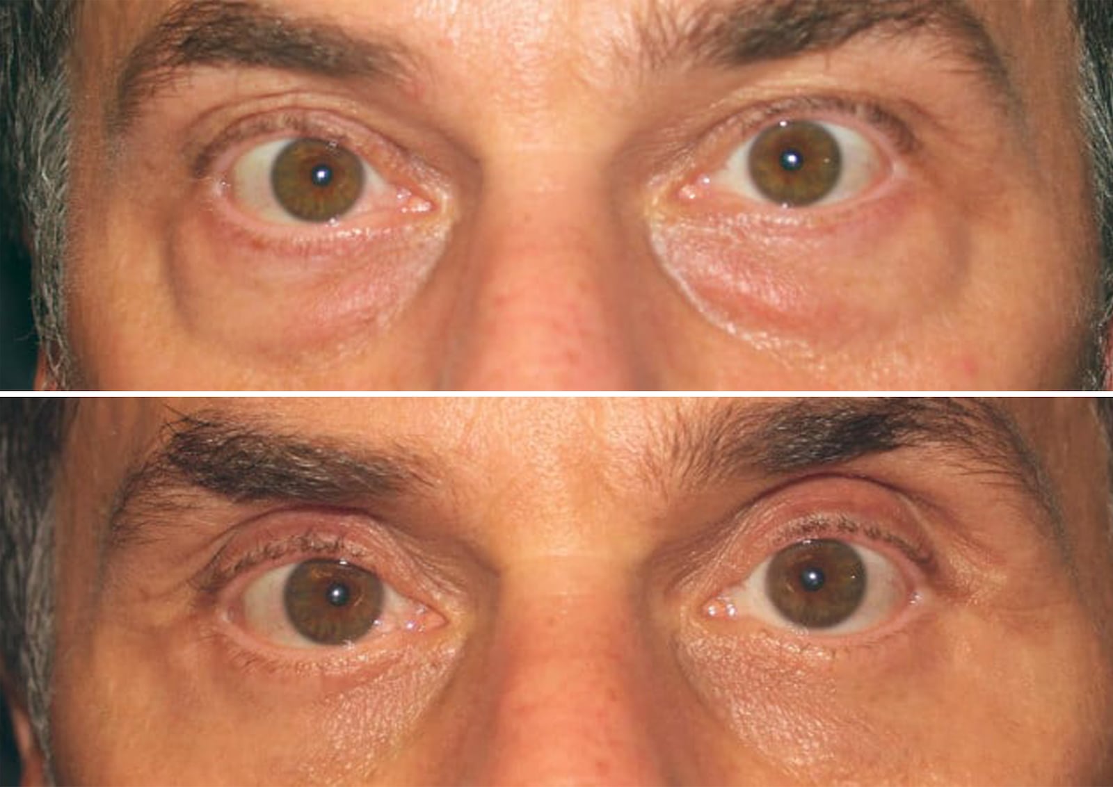 Lower blepharoplasty eyelid surgeries before and after.