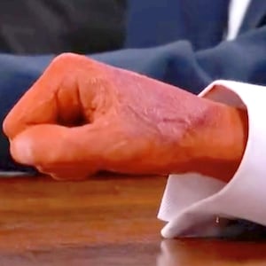 Donald Trump's fake bruised hands.