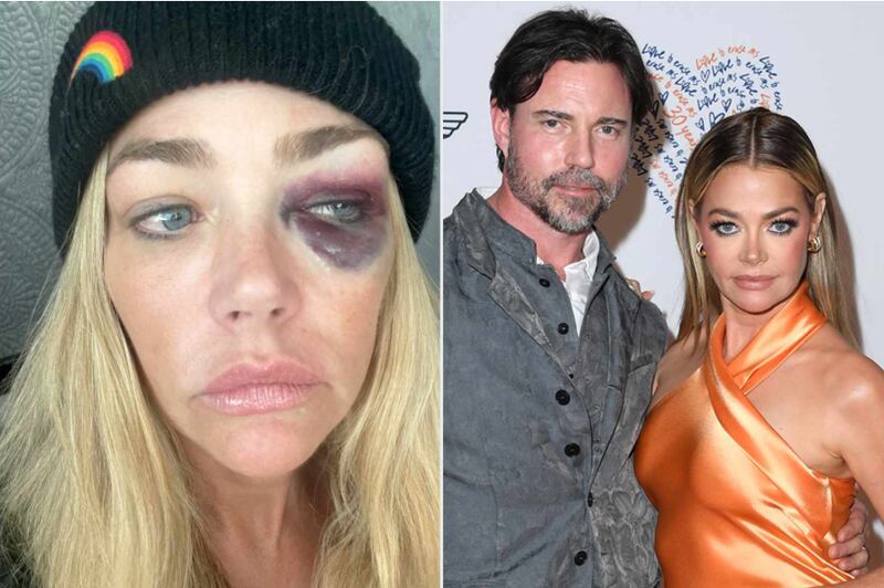 Denise Richards shares images of alleged domestic violence from estranged husband Aaron Phypers in new court documents.