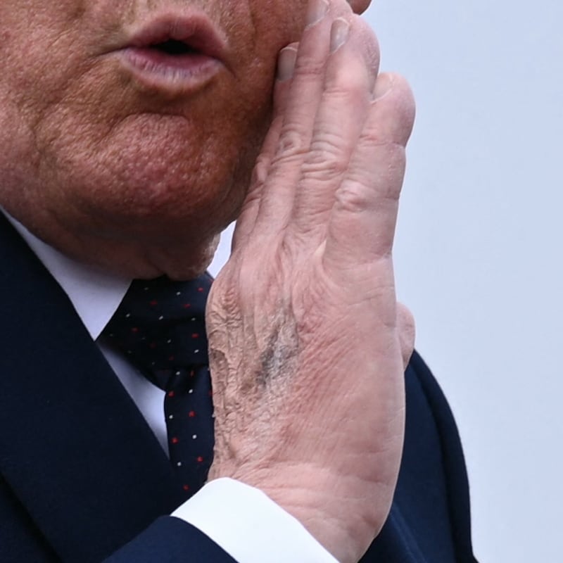 Trump shows his bruised hand while gesturing to reporters on his way to Air Force One.