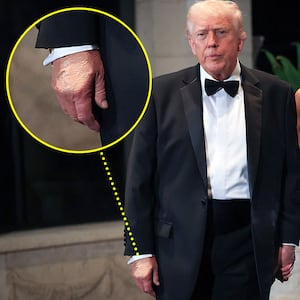 Donald Trump and Melania Trump on New Year's Eve with a close up of the makeup on Donald's hand