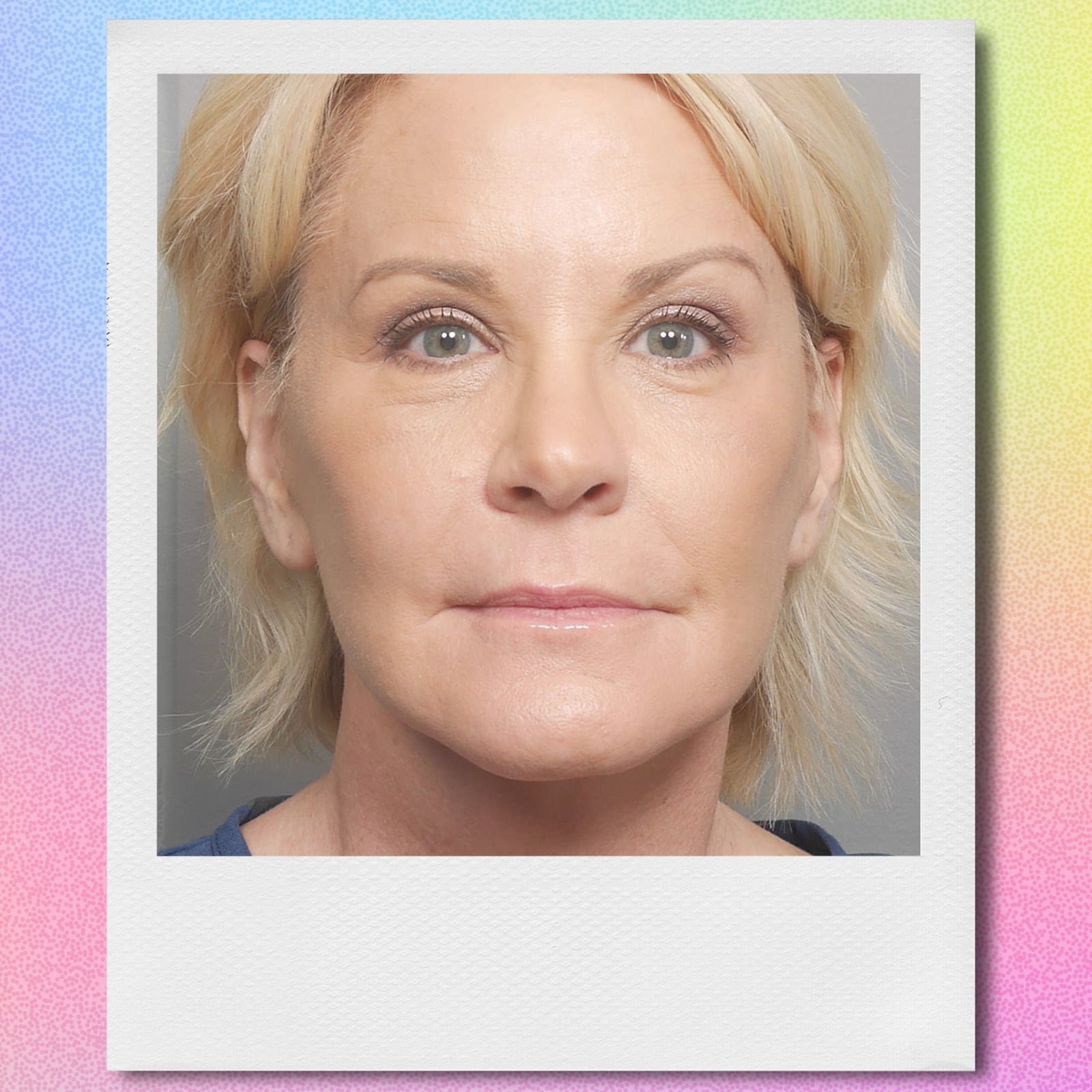 Deep plane face lift before and after. front view.