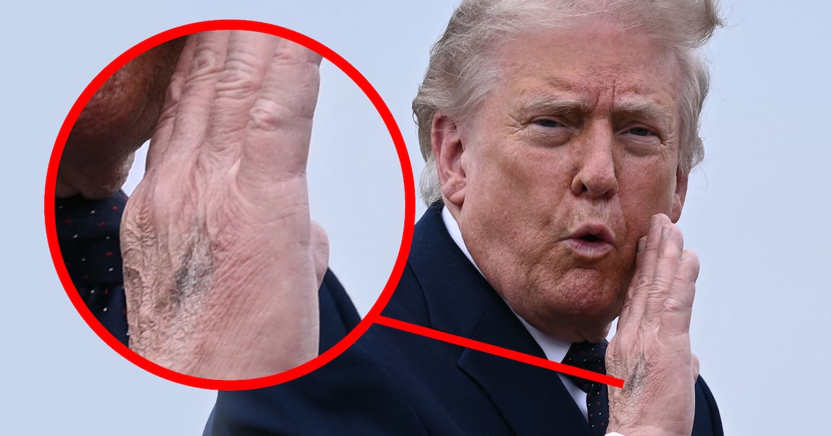 Trump, 79, Flashes Heavily Bruised Hand Ahead of Holiday Weekend