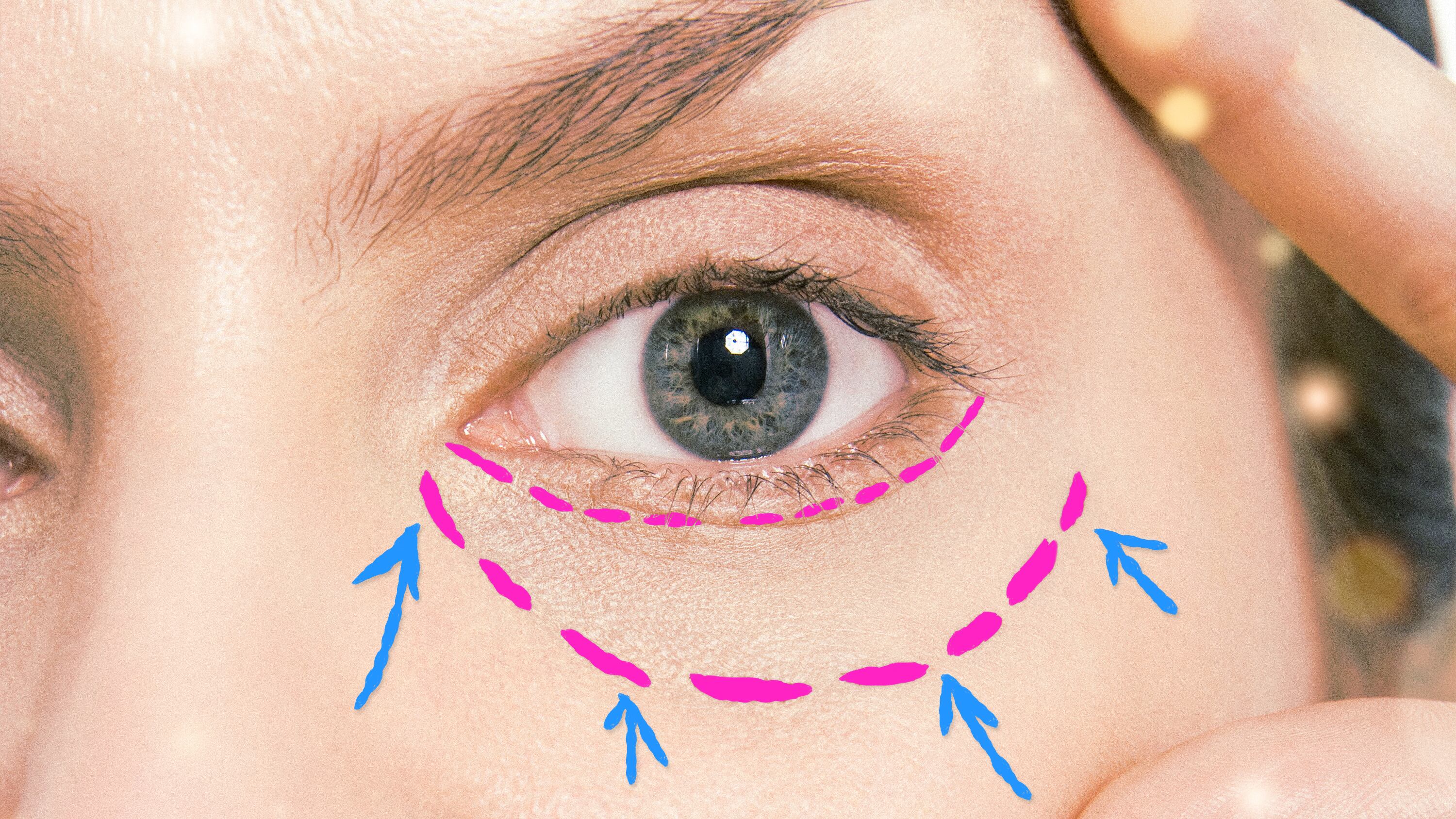A photo illustration of lower blepharoplasty eyelid surgery markings.