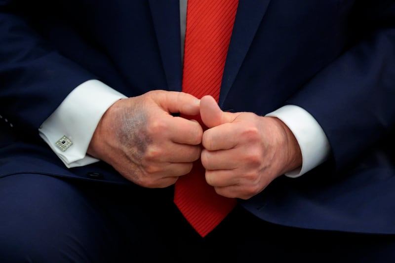 WASHINGTON, DC - AUGUST 25: A bruise is visible on the back of U.S. President Donald Trump's right hand during a meeting with South Korean President Lee Jae-myung in the Oval Office at the White House on August 25, 2025 in Washington, DC. White House Press Secretary Karoline Leavitt was asked about the bruising in February and she responded,