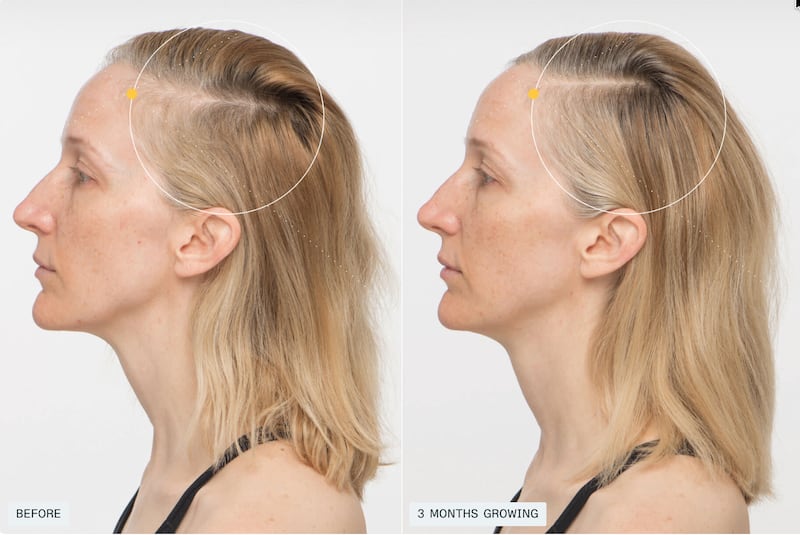 Nutrafol before and after