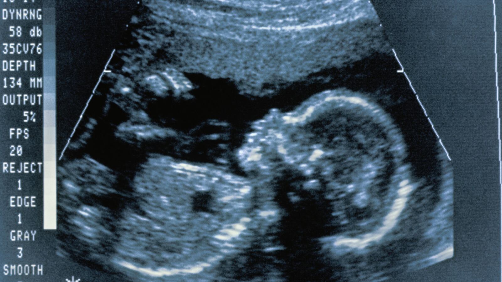 cheats/2012/06/06/testing-could-spot-disorders-in-fetuses/ultrasound-genetic-tests-tease_wam1ny