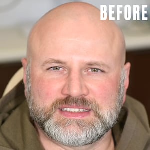 This Teeth Transformation Changed His Entire Smile for The Looker.