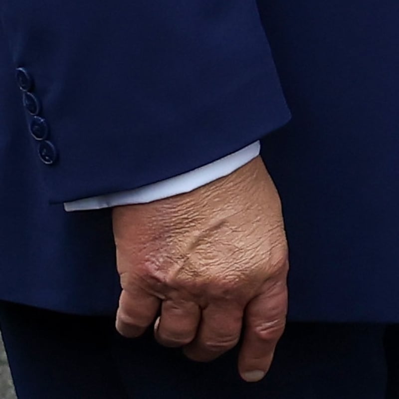 Trump often applies concealing makeup to the top of his right hand due to bruising.