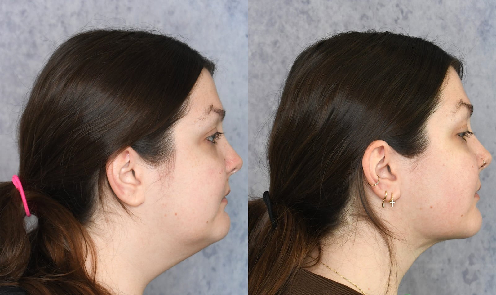A photo illustration of chin lipo suction before and after for the Looker.