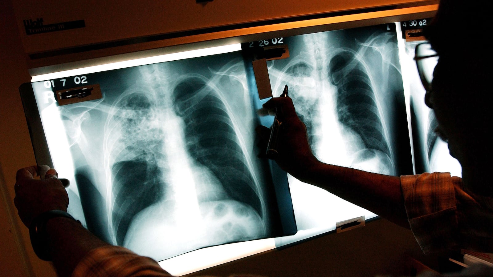 articles/2014/04/16/following-tuberculosis-from-death-sentence-to-cure/140515-Goetz-tb-death-sentence-tease_l7aseg