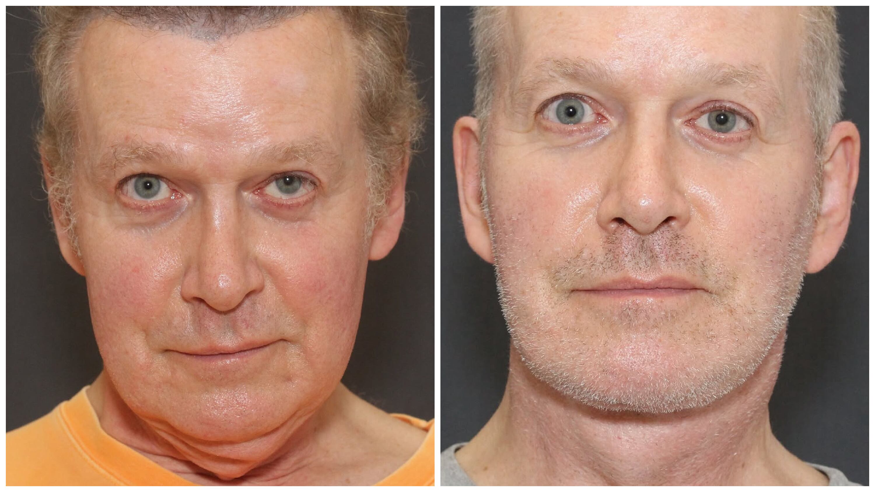 John Spaedy's plastic surgery transformation