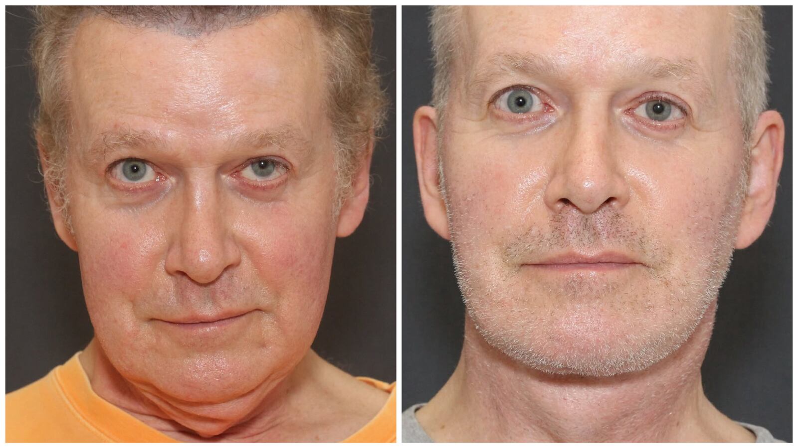 John Spaedy's plastic surgery transformation