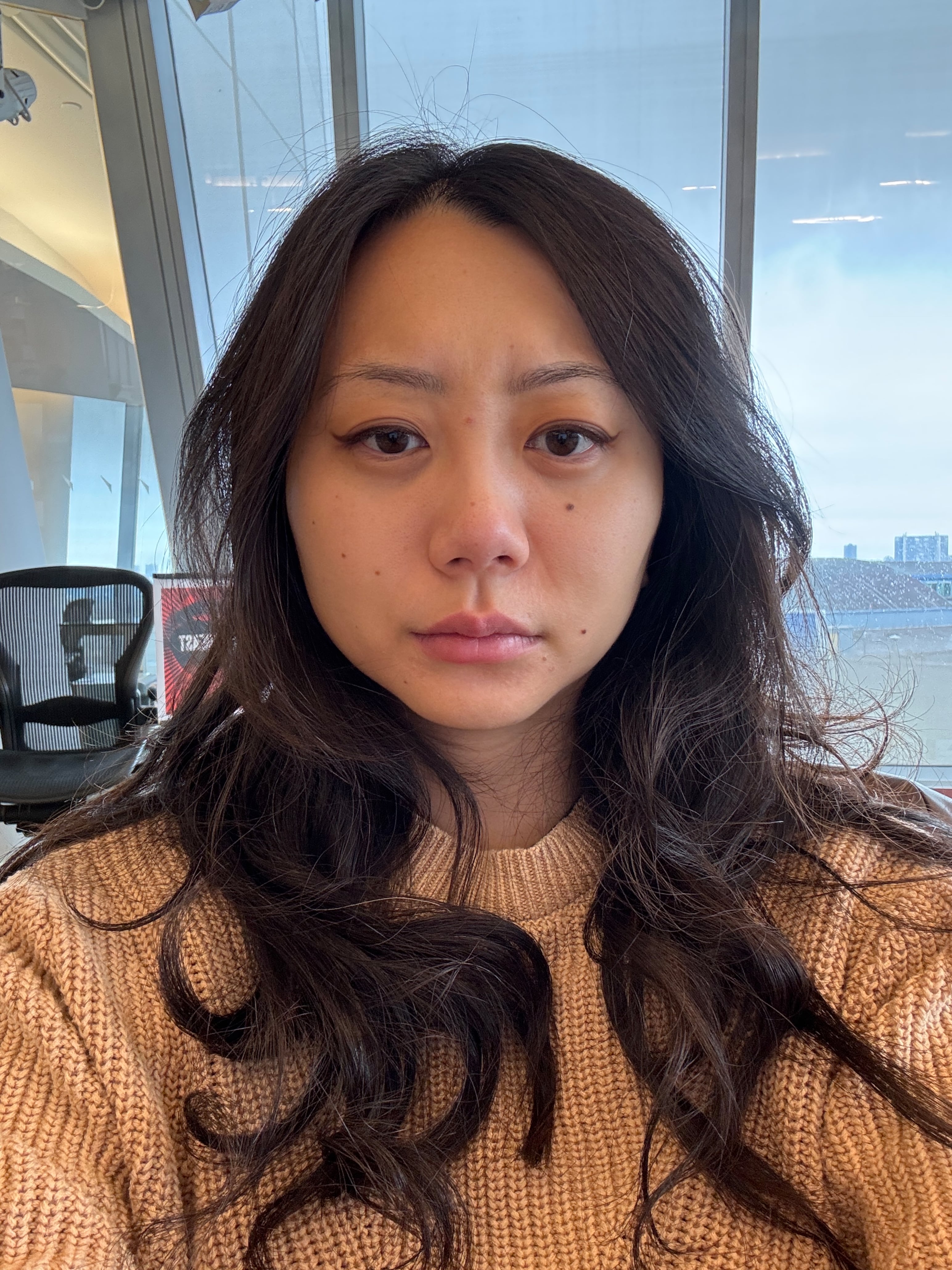 Frowning with baby botox.