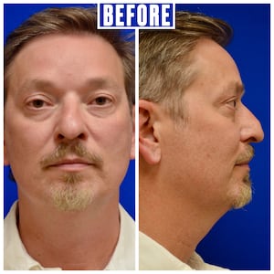 For His 50th Birthday, He Got Six Plastic Surgery Procedures for The Looker
