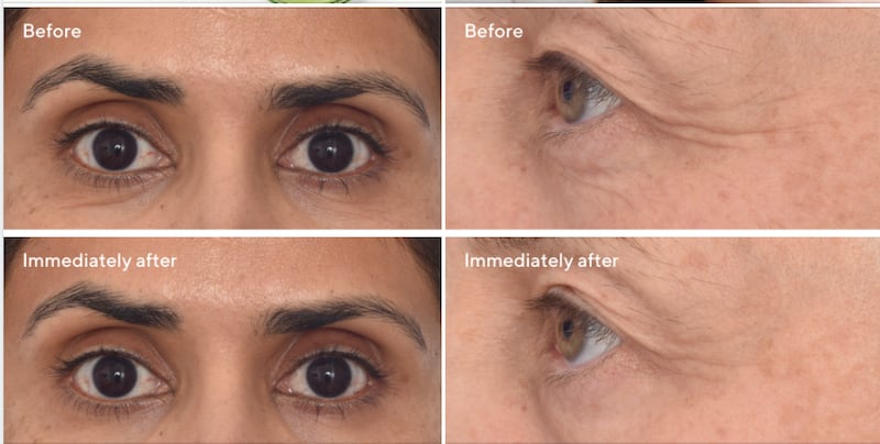 Murad eye mask dr zion before and after