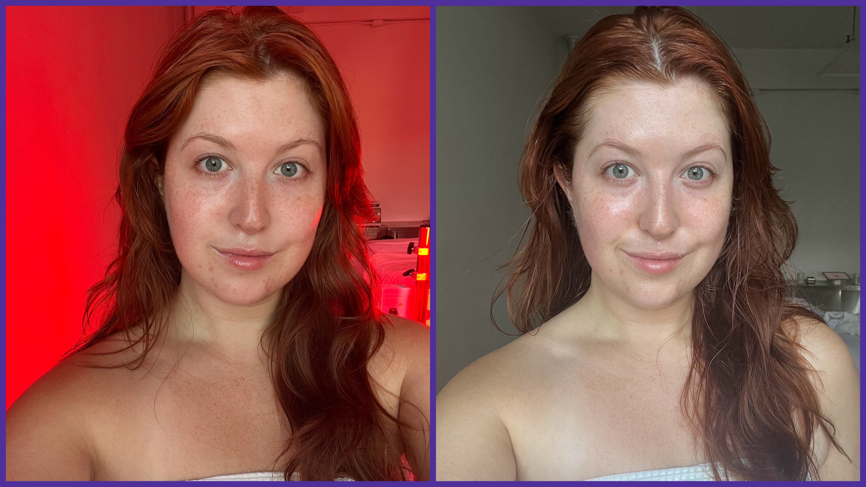 Mary Honkus before and after pictures of buccal fat removal