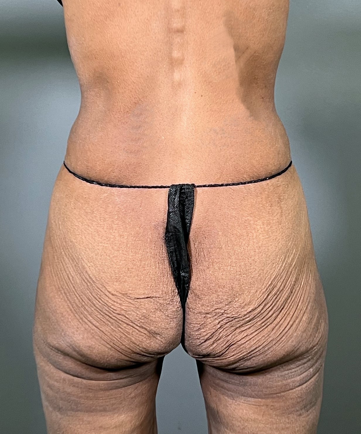 Ozempic patient's body before and after.