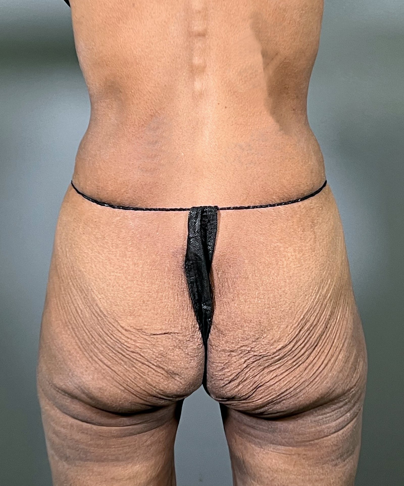 Ozempic patient's body before and after.