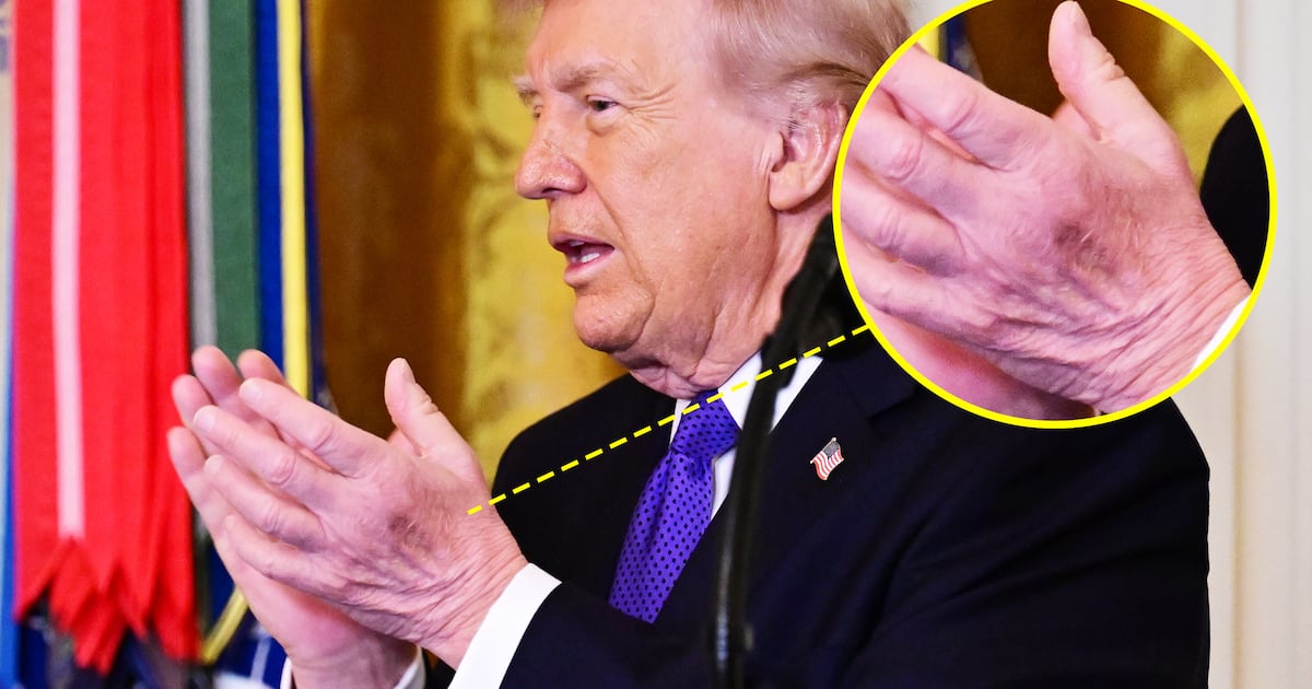 Trumps Hautausschlag am Hals lenkt von neuer Prellung an seiner „guten“ ...