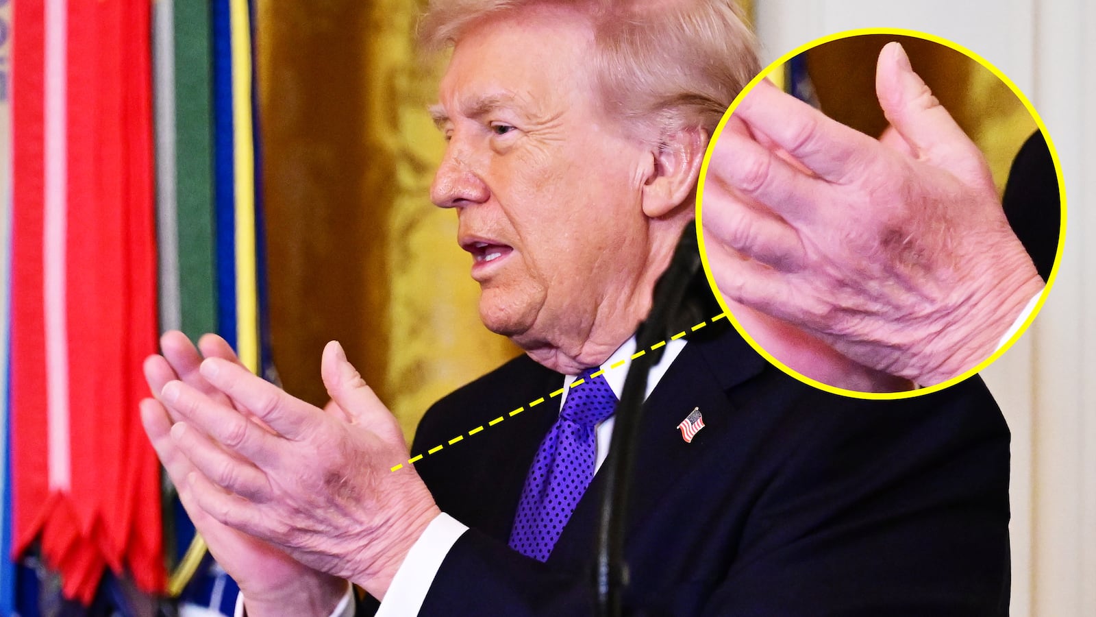 Donald Trump and his hand bruise.
