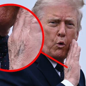 A close-up of Trump's discolored hand.