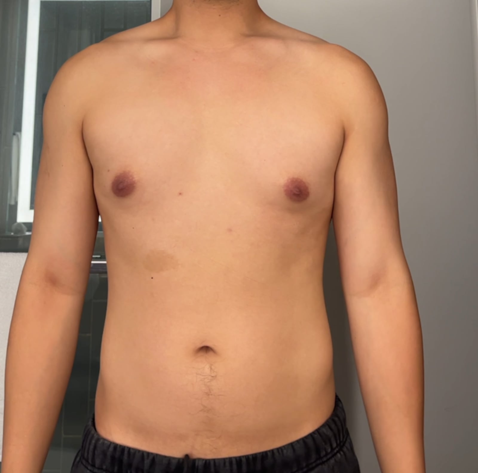 Jon Michael's gynecomastia before.