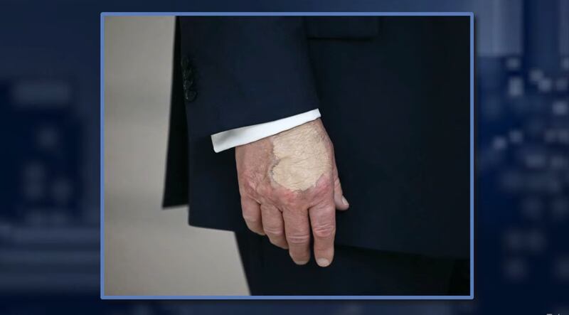 Jimmy Kimmel Live!, a close-up picture of Trump's bruised hand covered in apparent make-up.