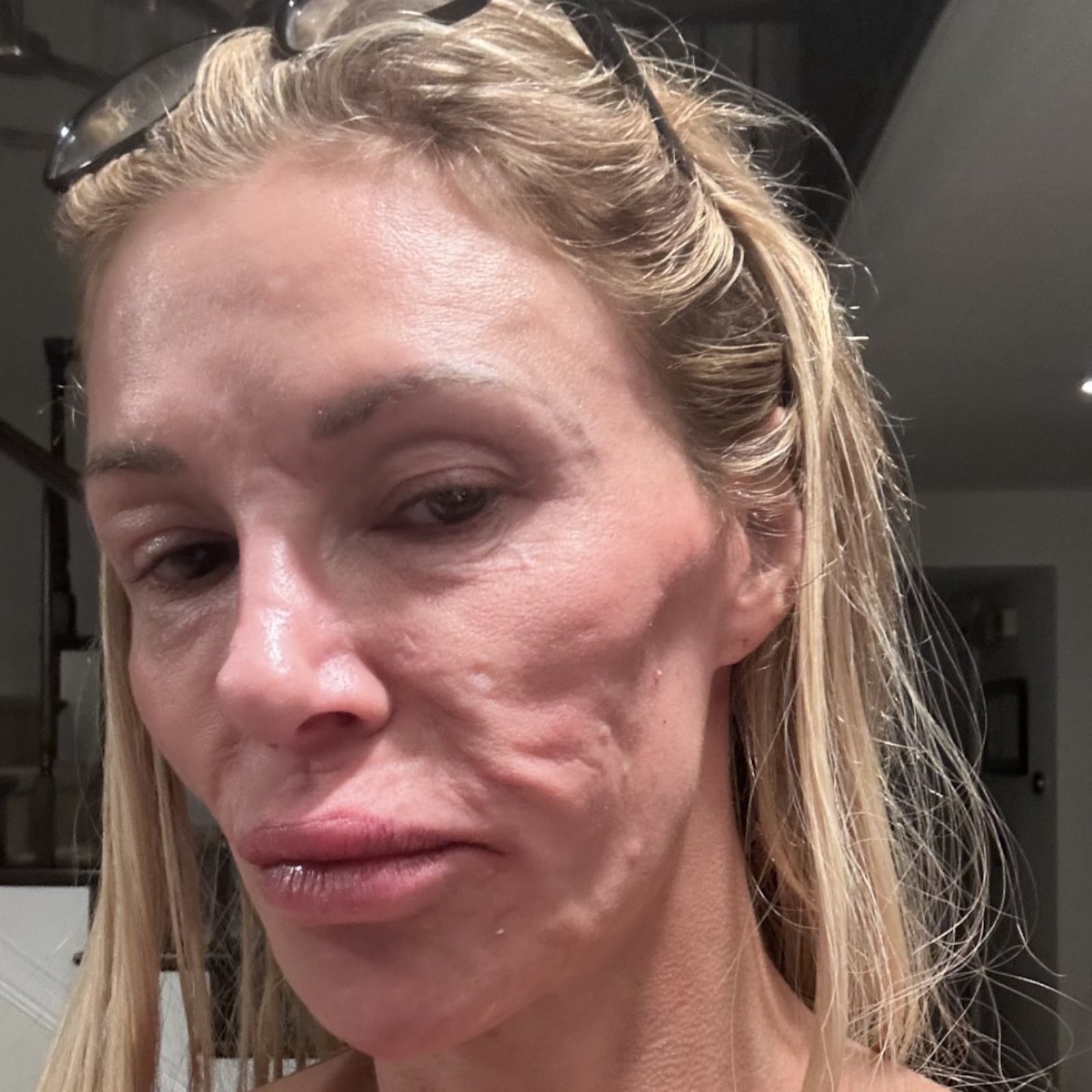 Doctors blamed parasites for Brandi Glanville's swollen face.