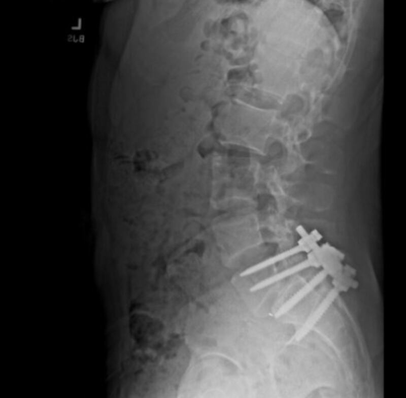 Luis Mangione posted an x-ray of a spinal surgery on his X profile.