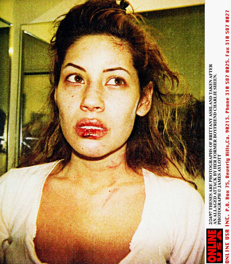 2/24/97 These are the photographs taken of Brittany Ashland after she was allegedly attacked by Charlie Sheen