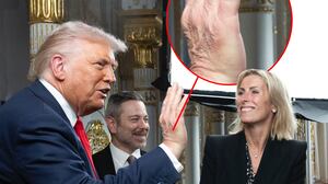 Donald Trump greets CBS executives with a bruised hand.