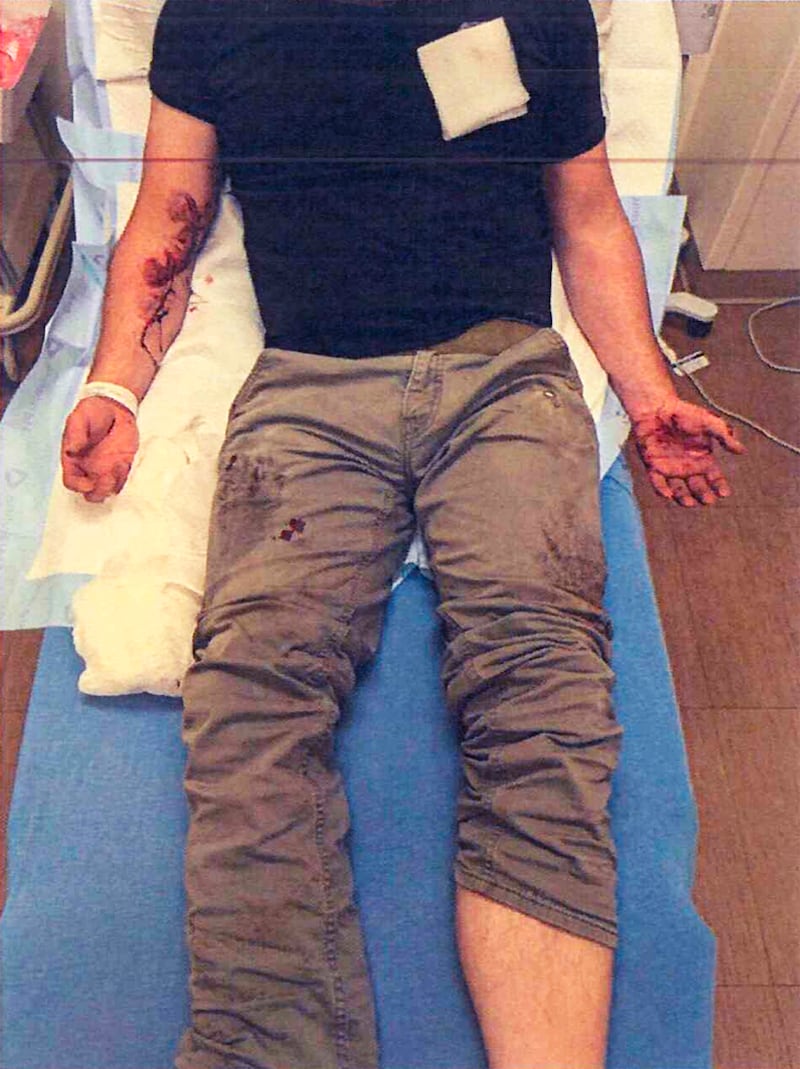 ICE agent Jonathan Ross on a hospital bed displaying his arms, one covered in blood from deep gashes in US District Court for the District Court of Minnesota document on June 17, 2025.