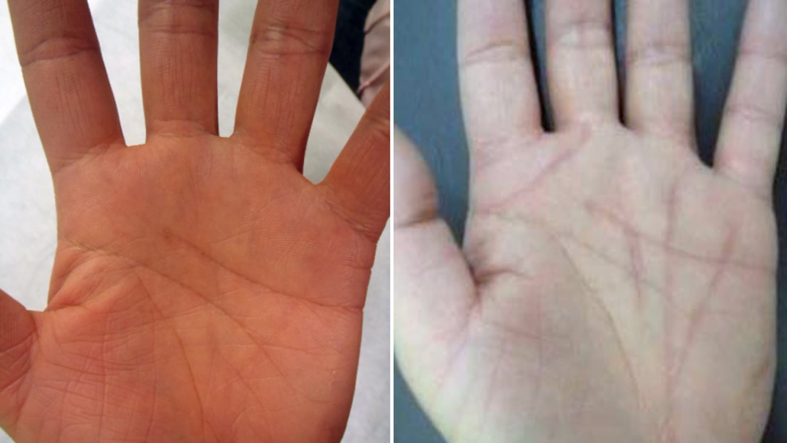 articles/2013/07/12/your-future-is-in-the-palm-of-your-surgeon-s-hand/130711-japan-palm-surgery-adelstein-tease_wc5vbl