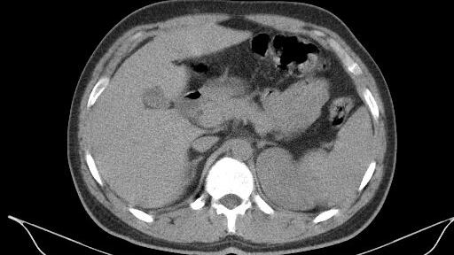 Computed tomography images of necrotizing fasciitis.
