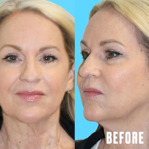 The Looker - This Woman's Facelift Had People Mistaking Her For Her Daughter