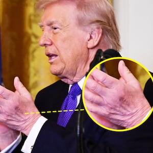 Donald Trump and his hand bruise.