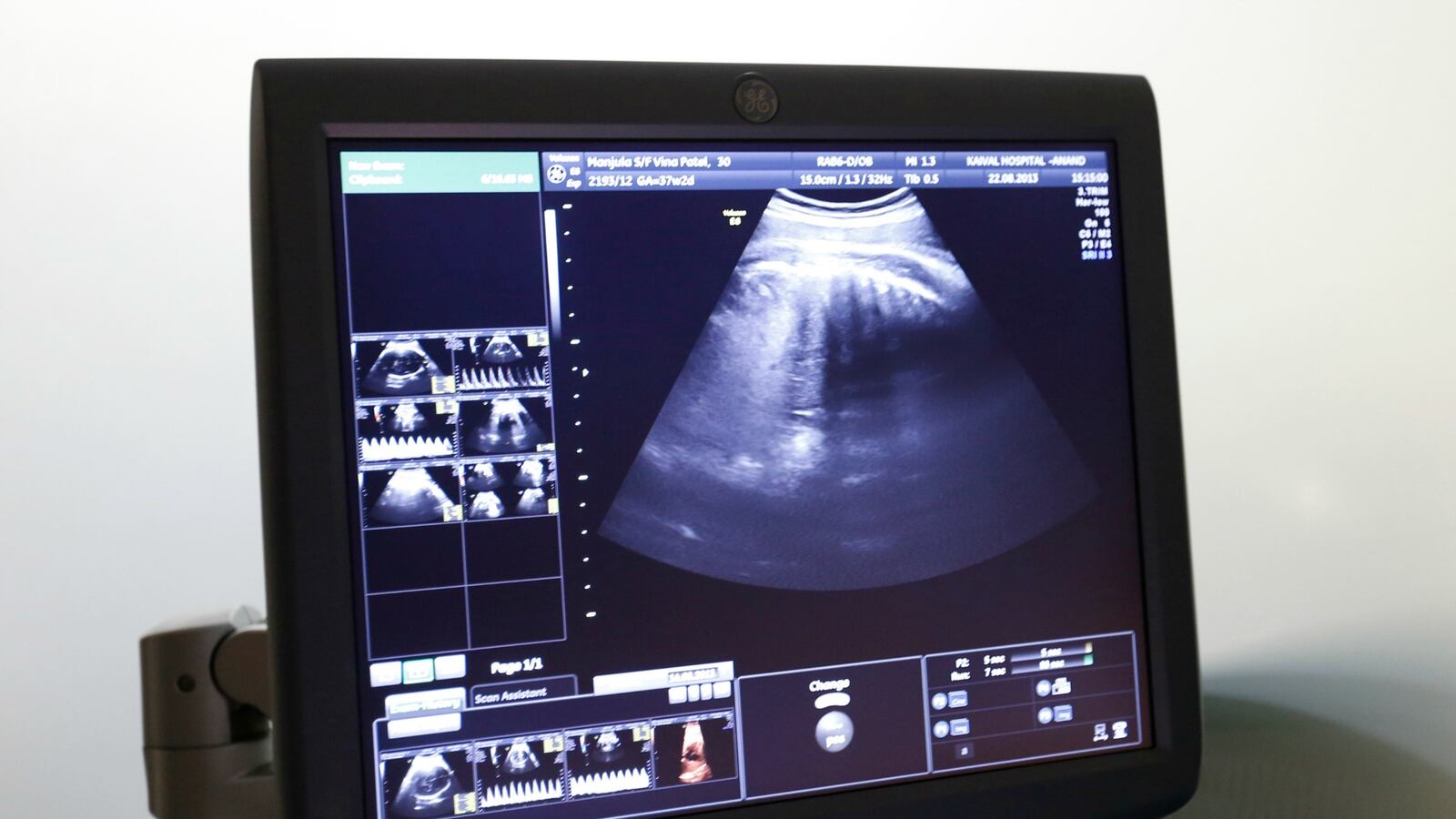 cheats/2016/07/01/woman-wins-right-to-use-dead-daughter-s-eggs/160701-eggs-ultrasound-cheat_dohzj3