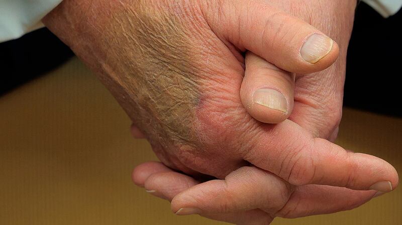 Makeup covers a bruise on the back of U.S. President Donald Trump's hand as he hosts French President Emmanuel Macron for meetings at the White House on February 24, 2025 in Washington, DC.