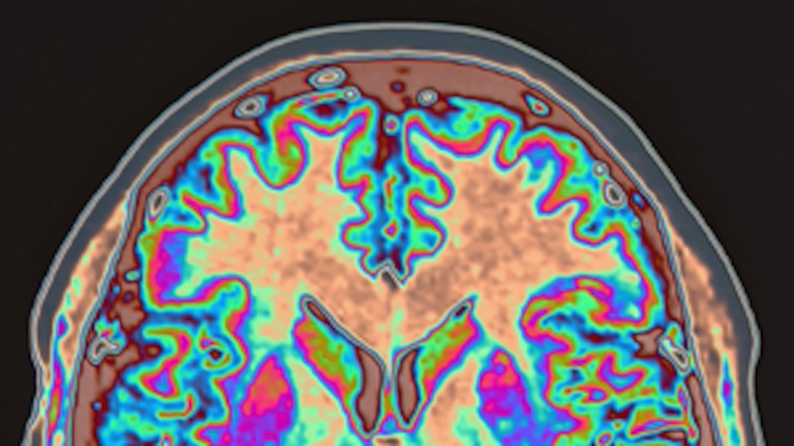 cheats/2011/06/01/woman-suffers-foreign-accent-syndrome/brain_mneyqy