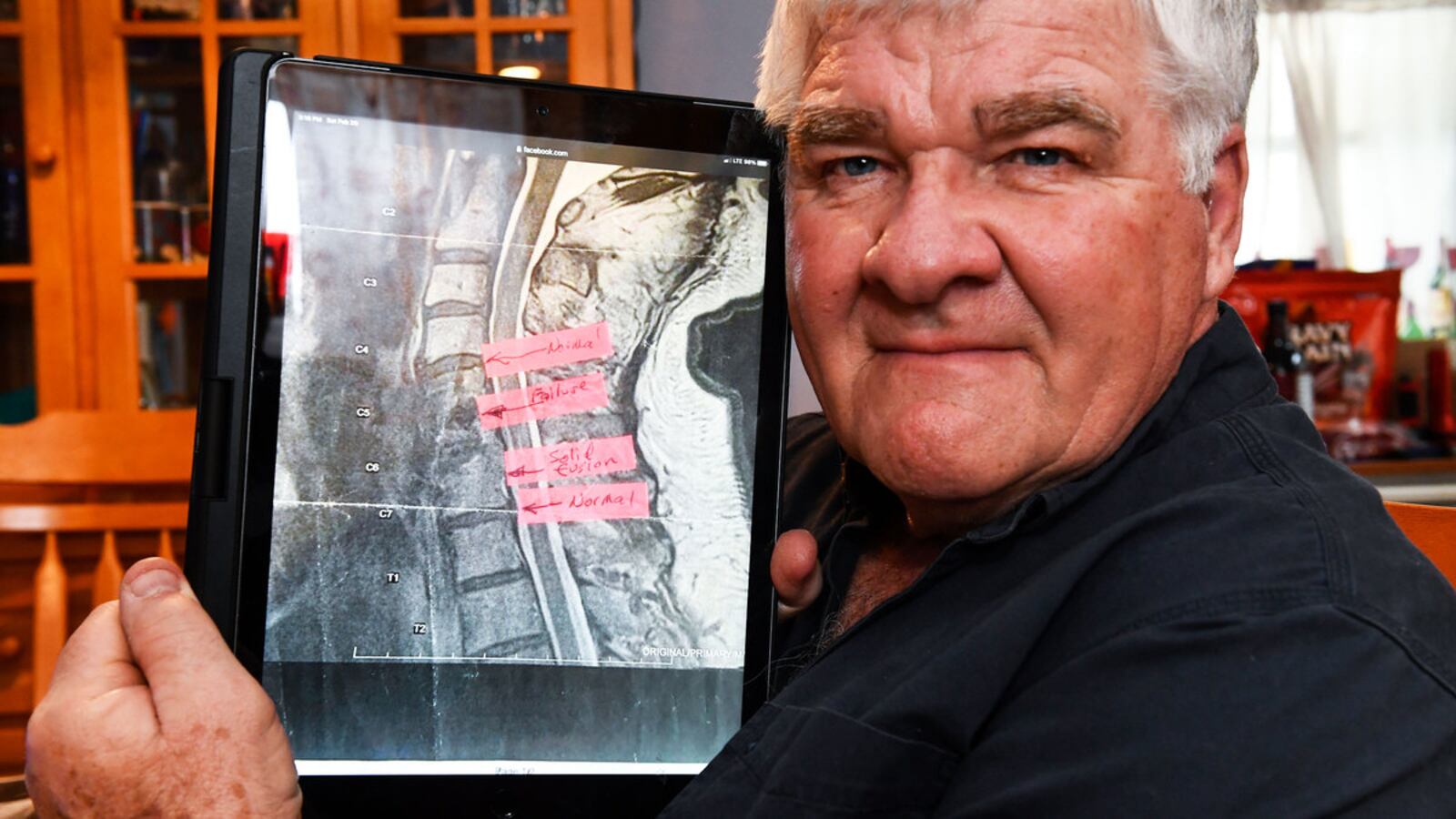 210806-KHN-implants-teasetease_ojnlm5