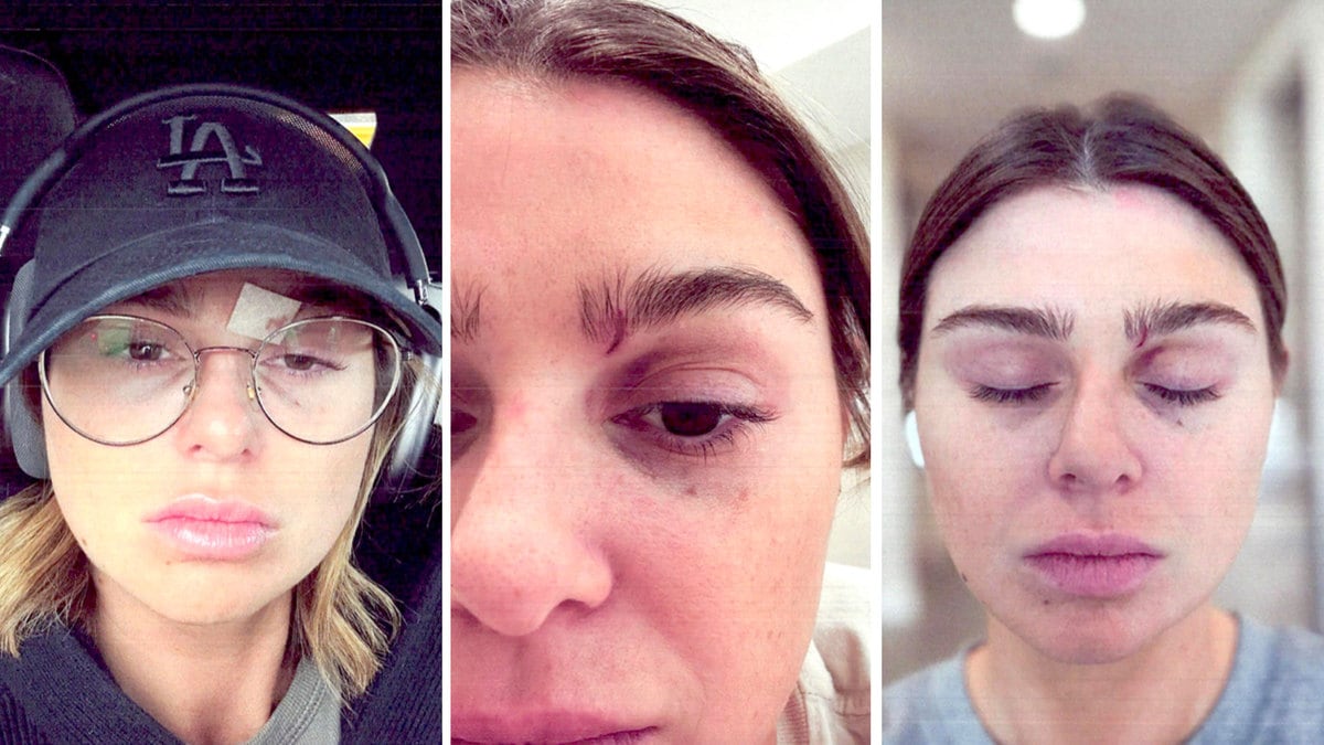 Raquel Leviss shares photos of bruising in a restraining order filing