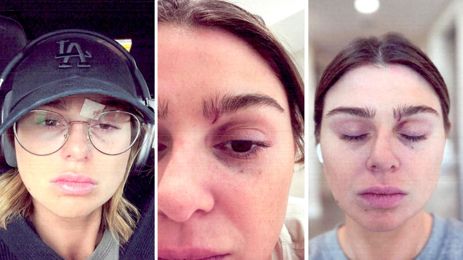 Raquel Leviss shares photos of bruising in a restraining order filing