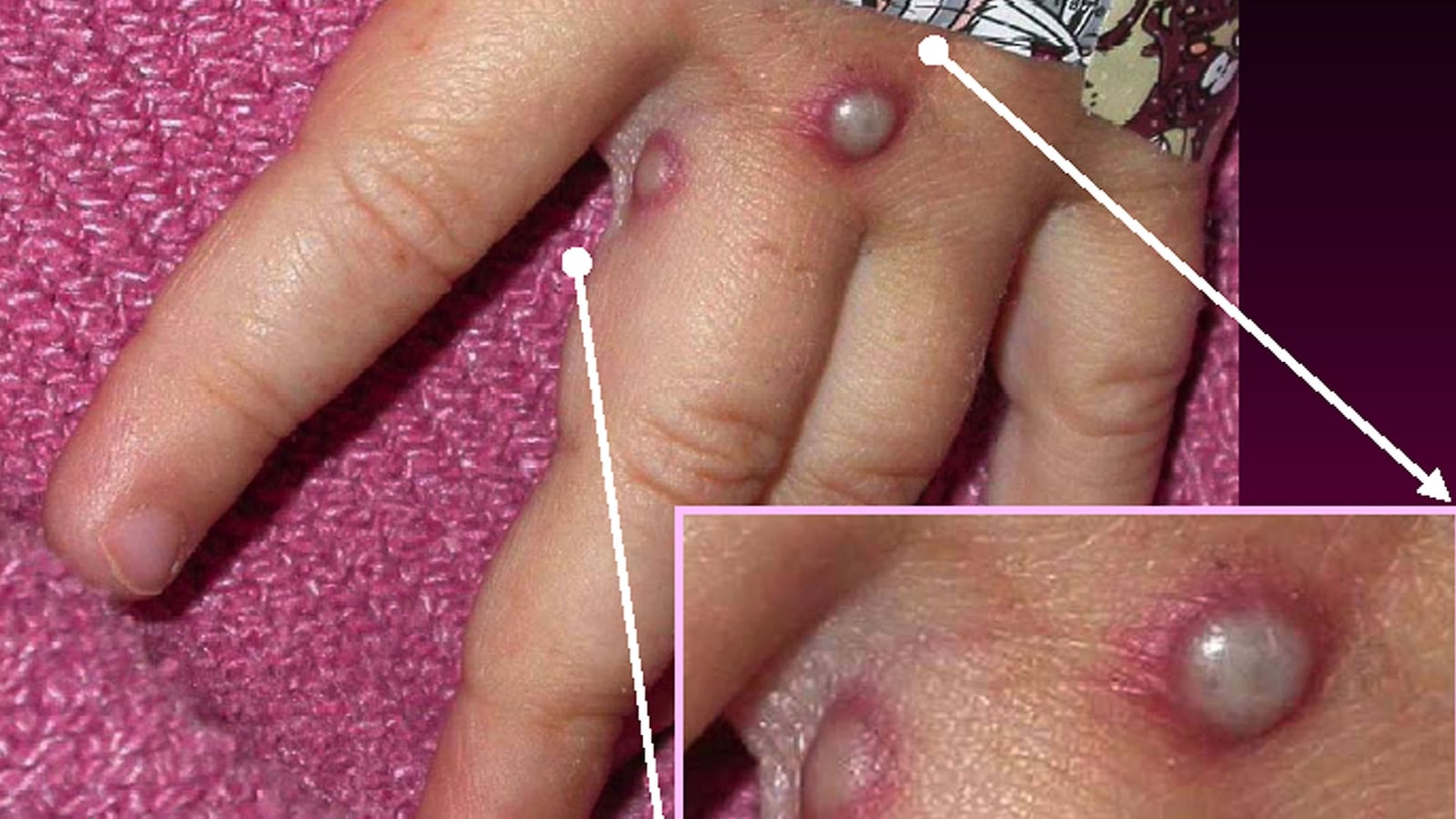 monkeypox_nyc_xxkiey